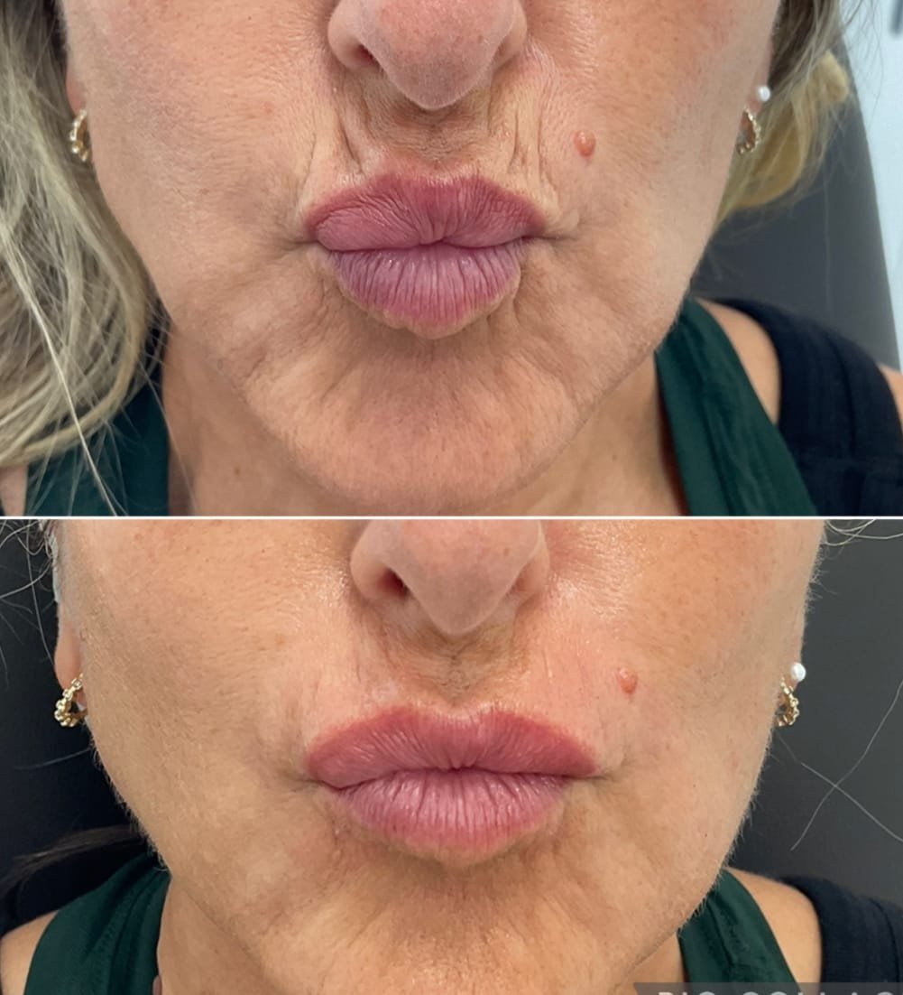 Side-by-side images showing Skin Booster results in the lip area, performed by Nurse Jacklyn.
