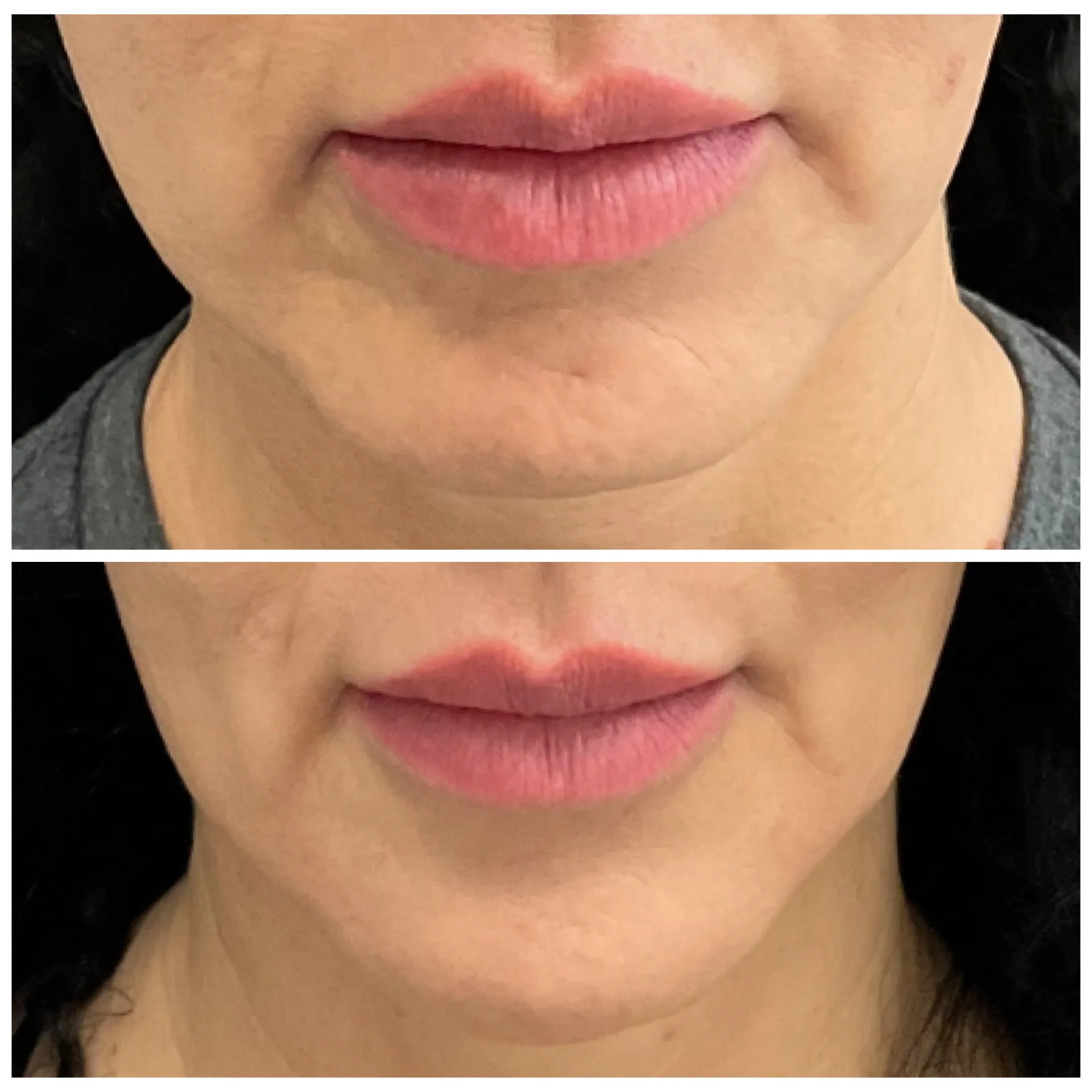 Side-by-side images showing Skin Booster results in the lip area, performed by Nurse Jacklyn.