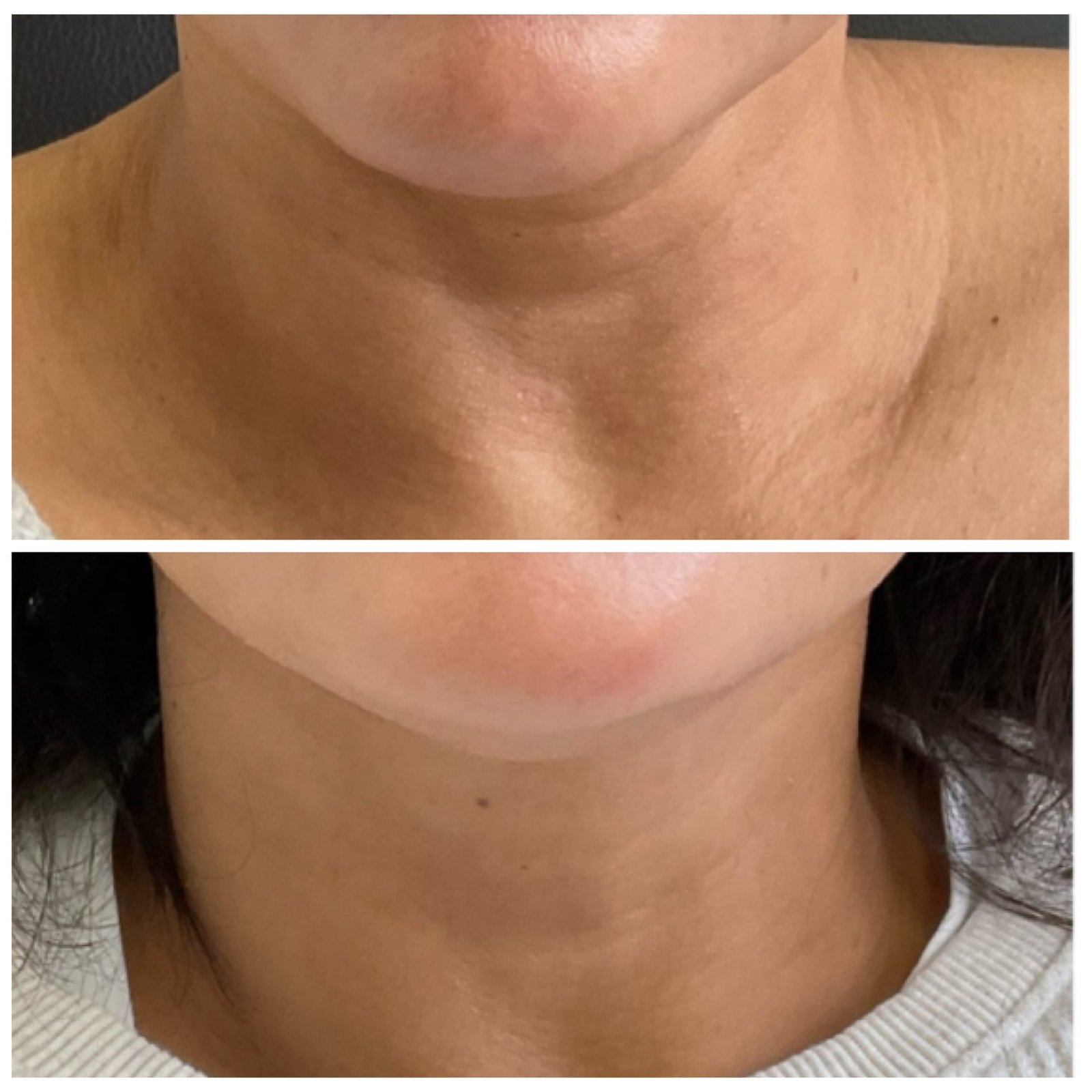 Side-by-side images showing Skin Booster results for neck lines, performed by Nurse Jacklyn