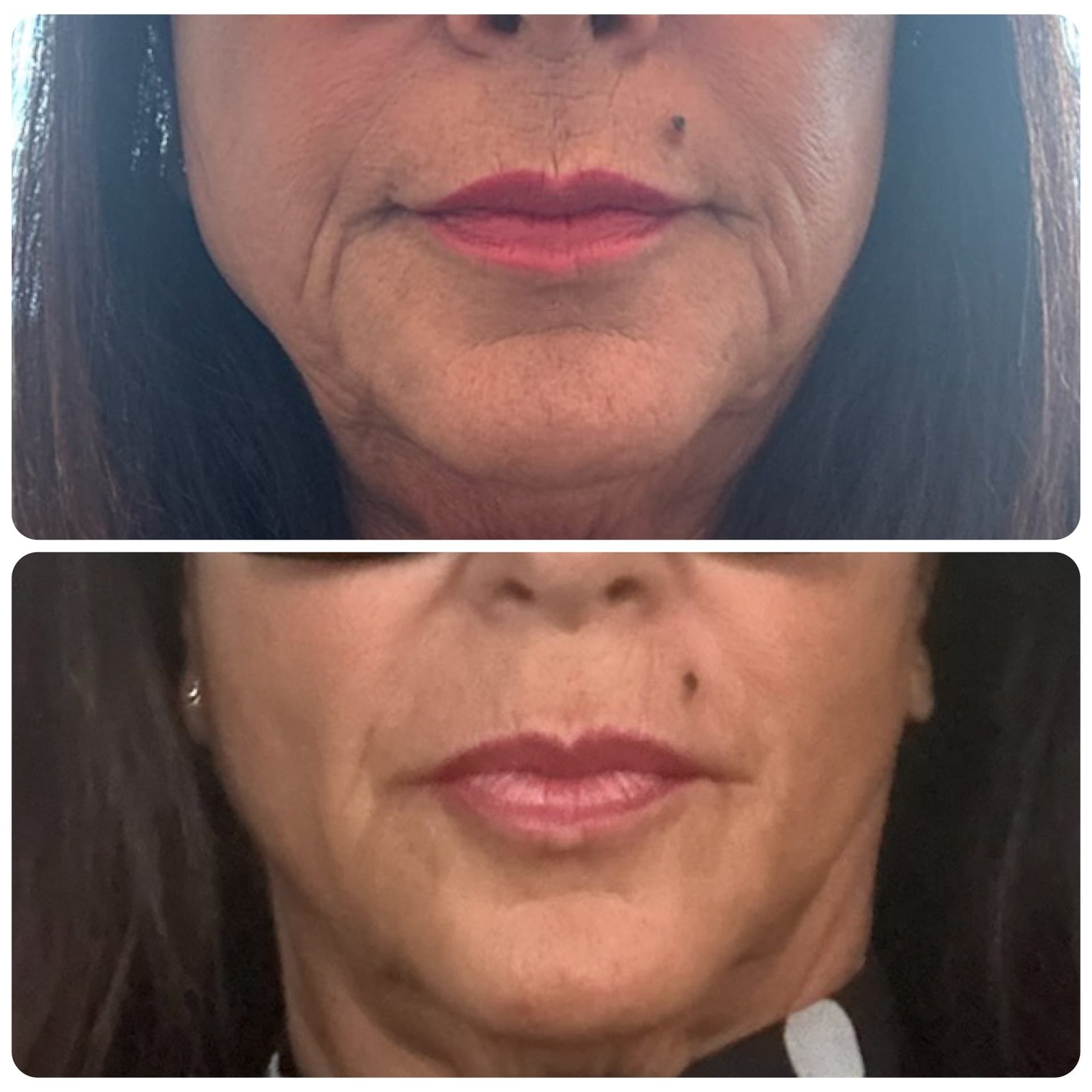 Side-by-side images showing Skin Booster results to the perioral area, performed by Nurse Jacklyn.