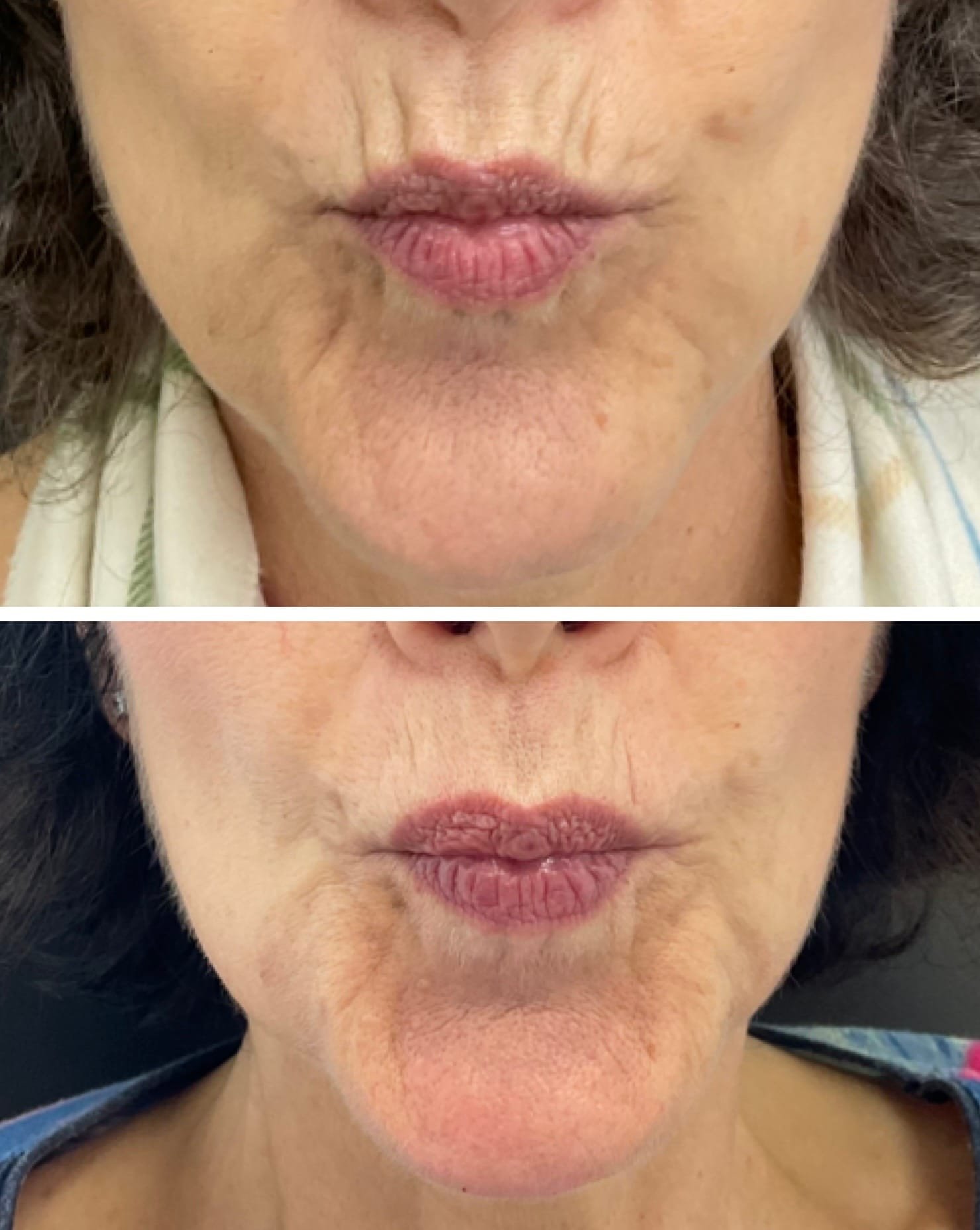 Before and After Results for Smile lines with Skin Boosters by Nurse Jacklyn