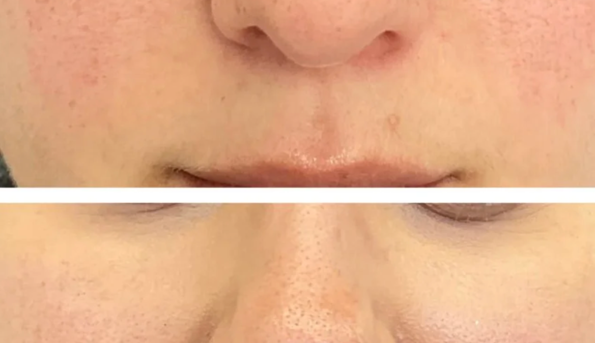 Before and after following treatment for pigmentation