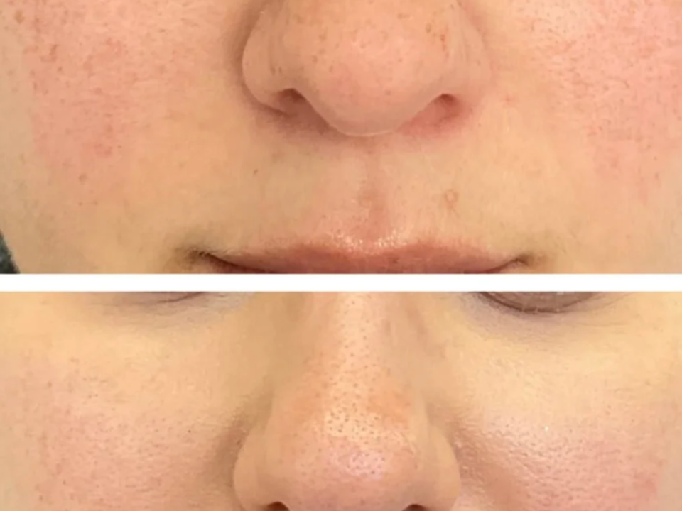 Before and after following treatment for pigmentation