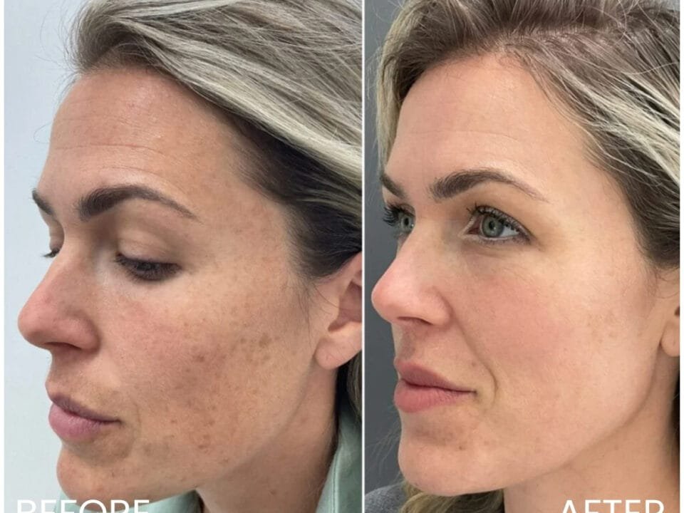 Before and After Post-Inflammatory Hyperpigmentation
