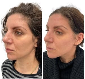 Ultherapy Before and After (1)