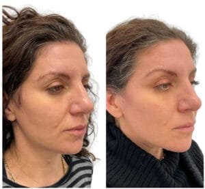 Ultherapy Before and After (2)