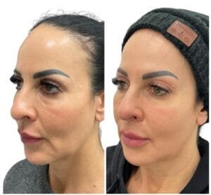 Ultherapy Before and After (3)