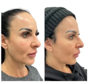 Ultherapy Before and After (4)