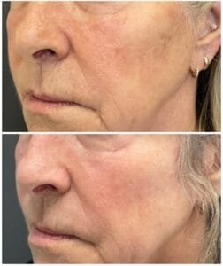 Before and After Contour TRL Pigmentation Nurse Jacklyn