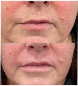 Before and After Laser (Laser resufracing updated)