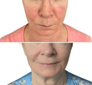 Before and After Redess: Rosacea (3)
