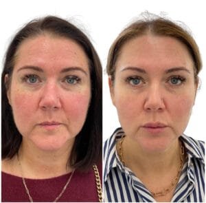 Before and After Redness & Rosacea by Nurse Jacklyn