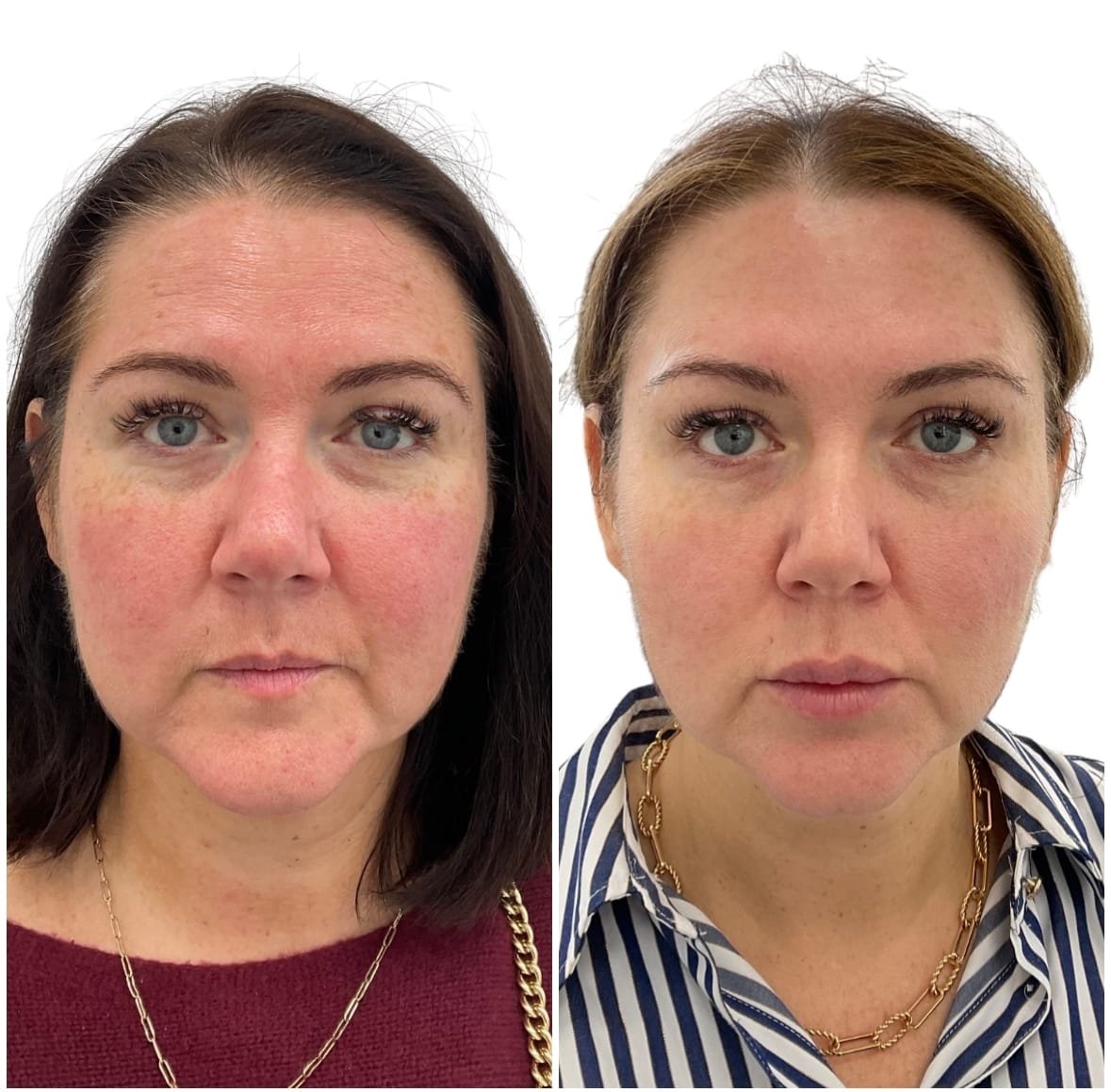 Before and After Redness & Rosacea by Nurse Jacklyn