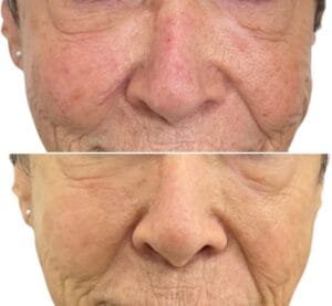 Before and After Rosacea (2.0)