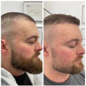 Acne Scar Before and After by Nurse Jacklyn