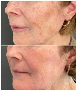 Pigmentation Before and After by Nurse Jacklyn