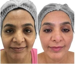 Before and After medical grade skincare by Nurse Jacklyn