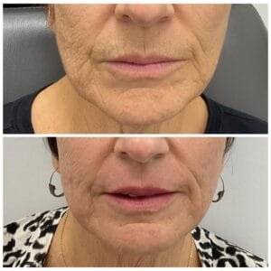 Before and After Erbium by Nurse Jacklyn