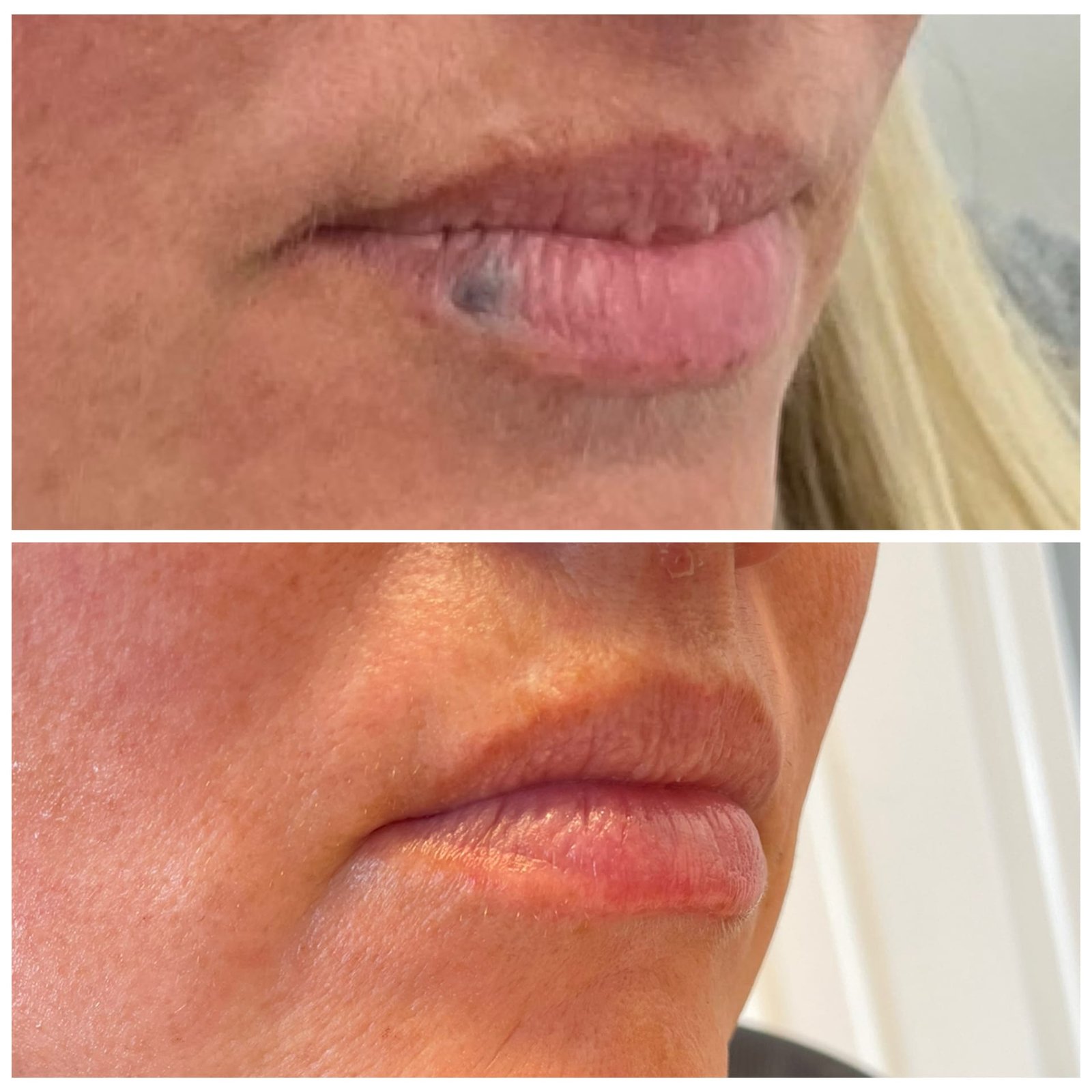 Before and After of a venous lake treatment with the ClearV Vascular Laser by Nurse Jacklyn