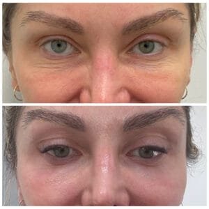 Before and After for Wrinkle treatment around the eyes with Sciton Contour TRL by Nurse Jacklyn