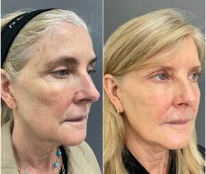 Before and After for a Sculptra treatment by Nurse Jacklyn in Oakville, ON