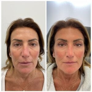 Before and After for a combination Ultherapy and Sculptra treatment by Nurse Jacklyn in Oakville, ON