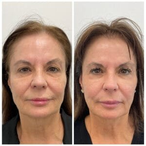 Before and After of a combination Contour TRL, Ultherapy Prime, and Sculptra Treatments by Nurse Jacklyn in Oakville, ON
