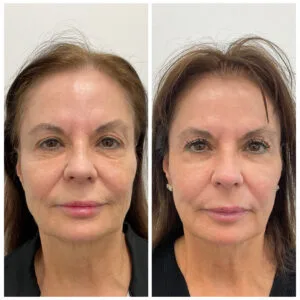 Before and After of a combination Contour TRL, Ultherapy Prime, and Sculptra Treatments by Nurse Jacklyn in Oakville, ON