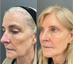 Before and After for a Sculptra treatment by Nurse Jacklyn in Oakville, ON