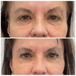Before and After Erbium Ablative Laser Resurfacing for skin laxity of the lower eyelids by Nurse Jacklyn