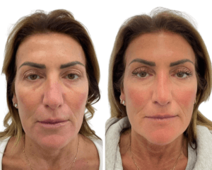 Before and After for a combination Ultherapy and Sculptra treatment by Nurse Jacklyn in Oakville, ON
