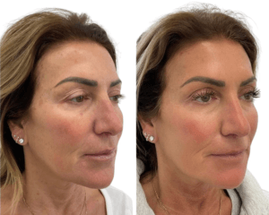 Before and After for a combination Ultherapy and Sculptra treatment by Nurse Jacklyn in Oakville, ON