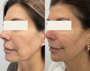 Before and After for jawline and cheek with Scupltra by Nurse Jacklyn